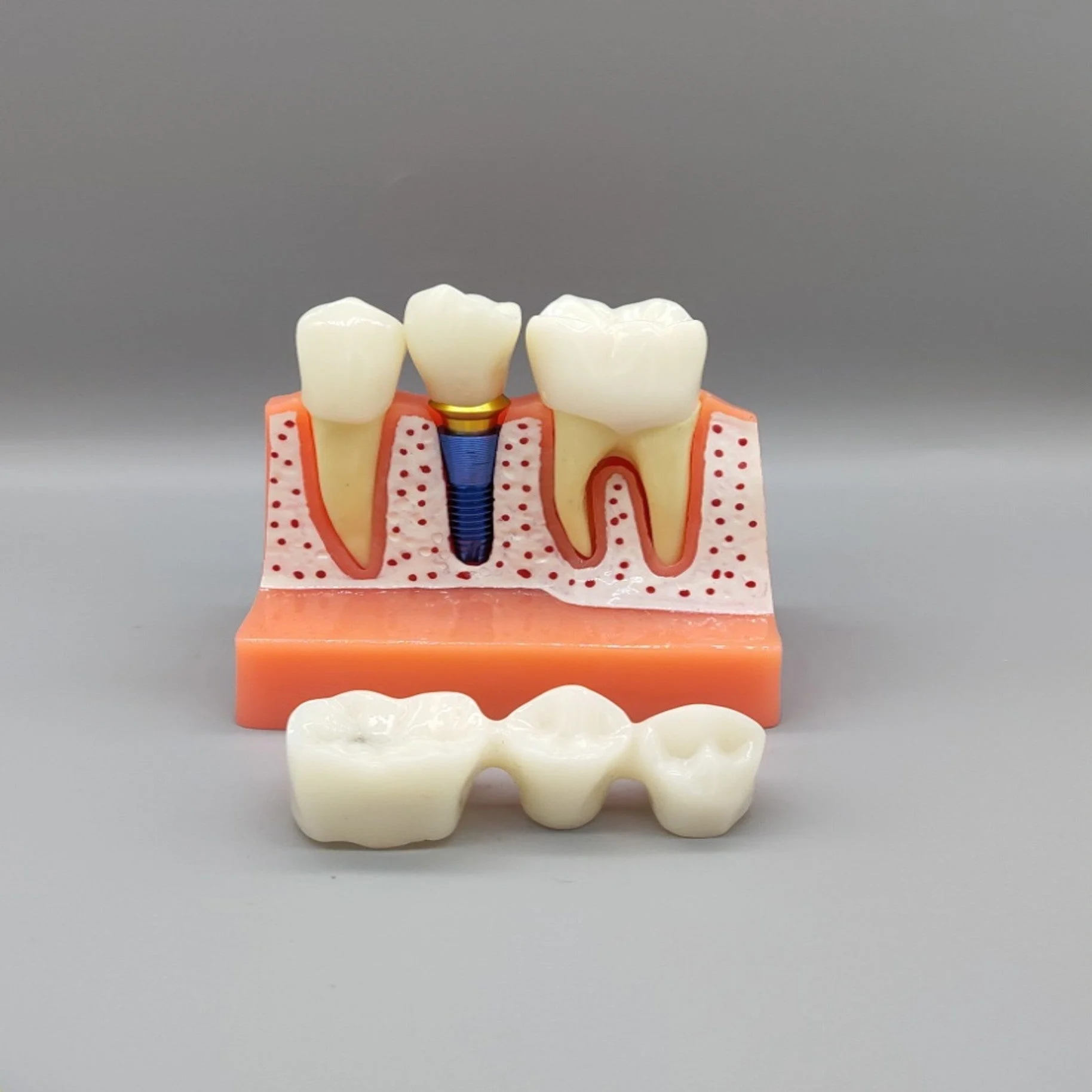 Dental Implant Educational Model (Copy)