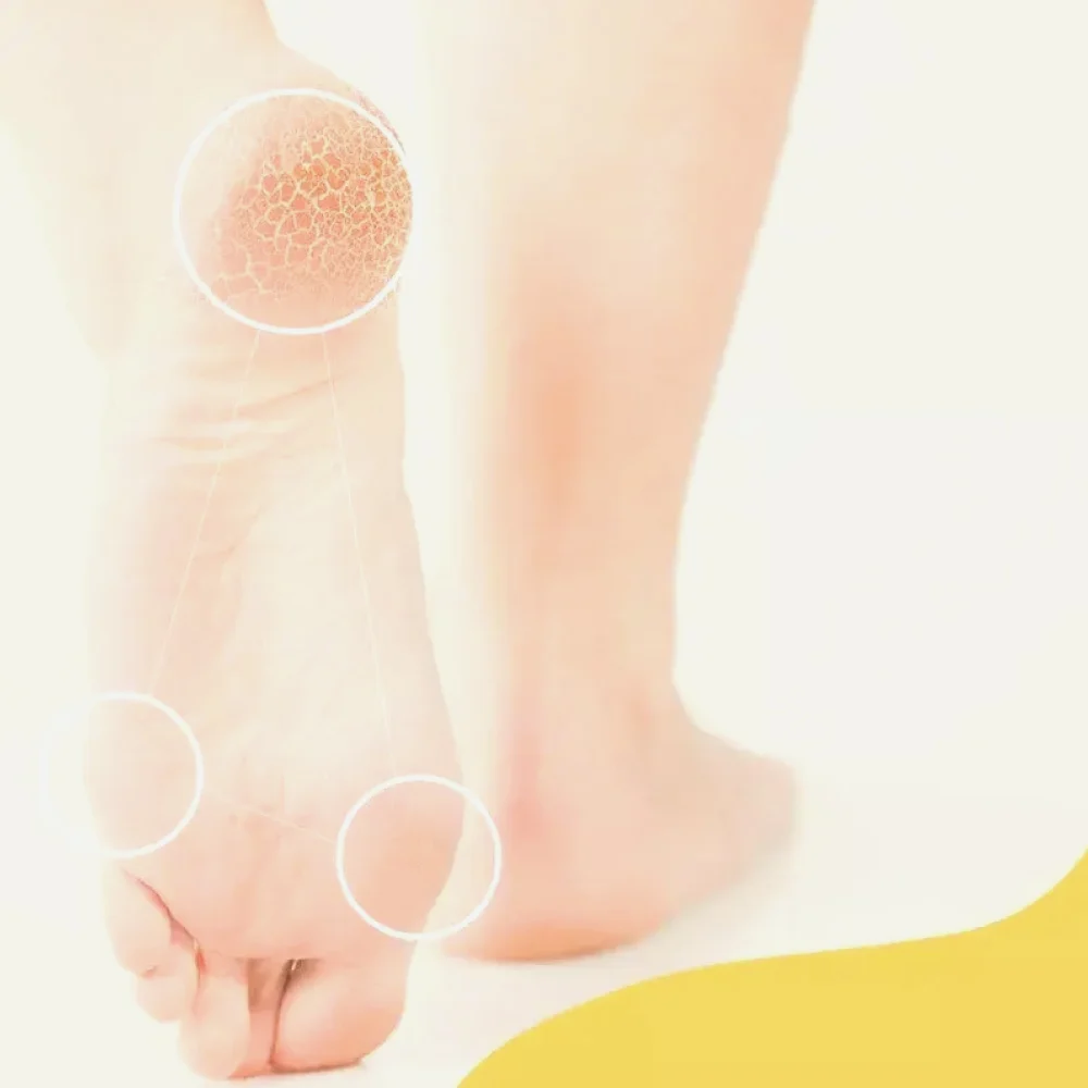 Scholl Callosities Cream